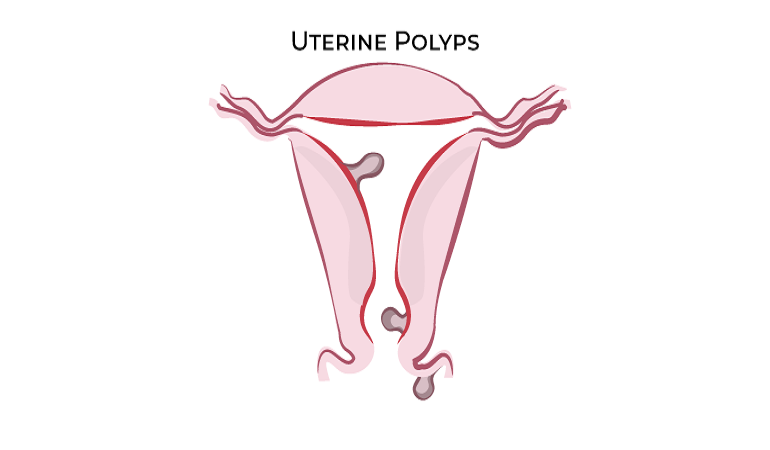 Endometrial-polyps-770x450