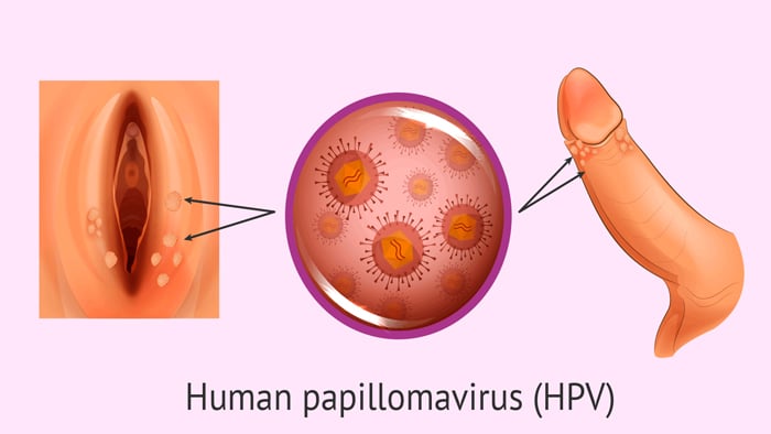 genital-warts1