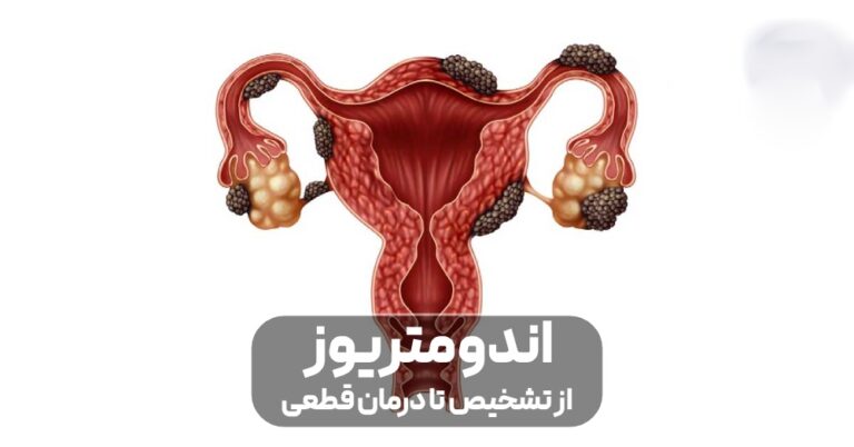 اندومتریوز؛ از تشخیص تا درمان قطعی (راهنمای جامع بیماران)