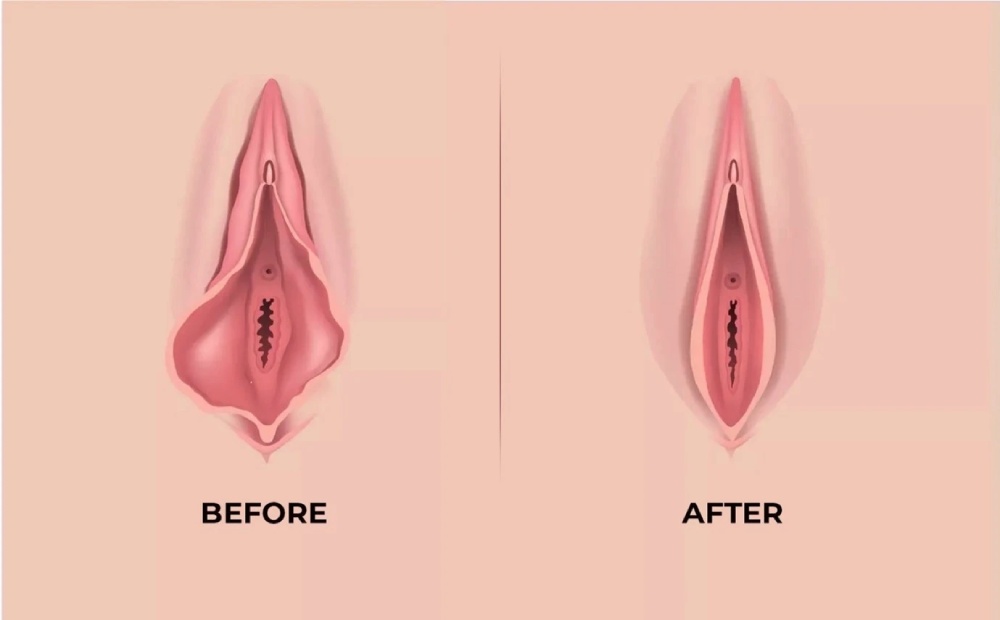 روش‌های انجام لابیاپلاستی 