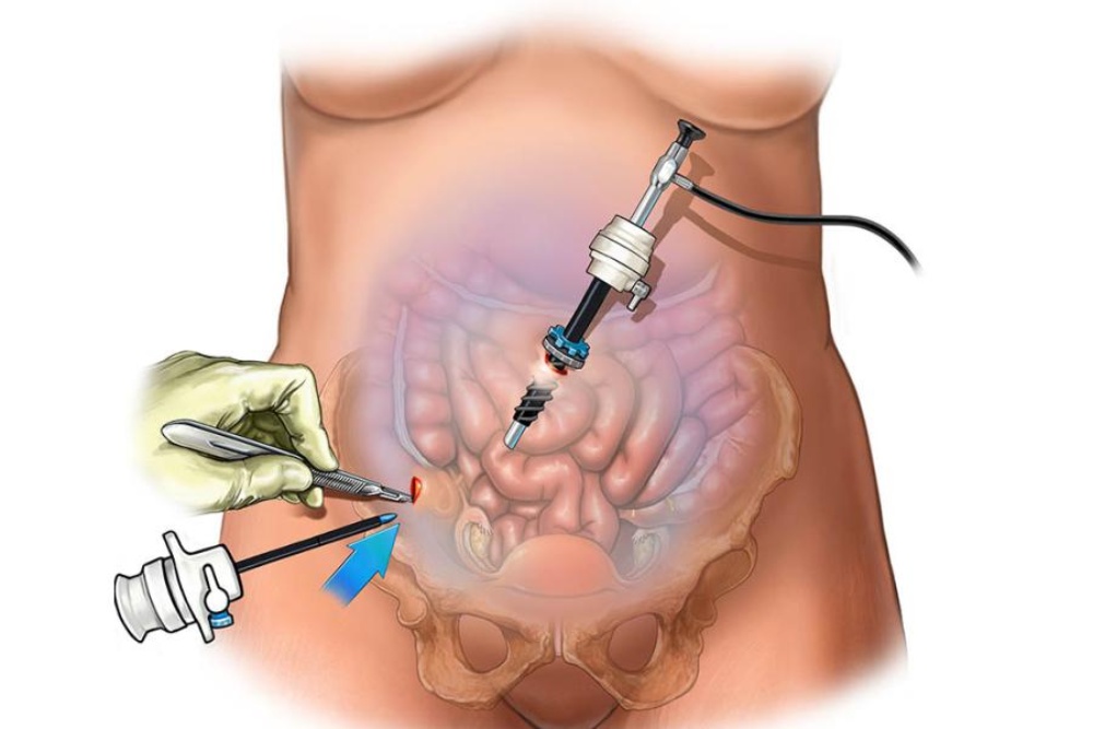 نحوه انجام لاپاراسکوپی ناباروری