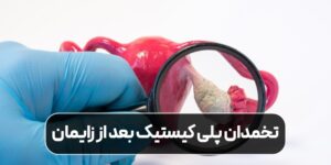 سندروم تخمدان پلی کیستیک بعد از زایمان