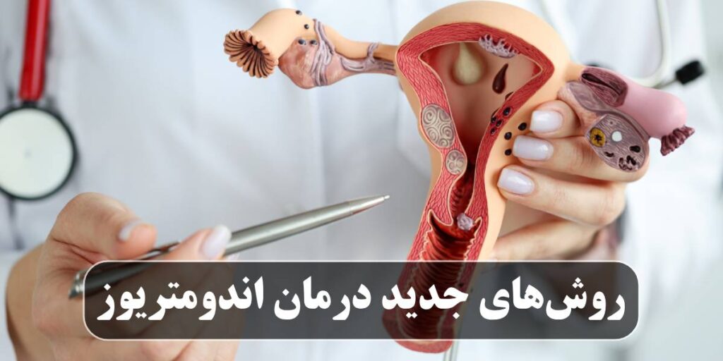 روش‌های جدید درمان اندومتریوز
