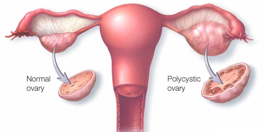 علائم تخمدان پلی کیستیک بعد از زایمان