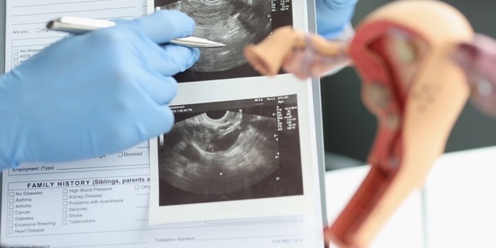 تشخیص تخمدان پلی کیستیک بعد از زایمان