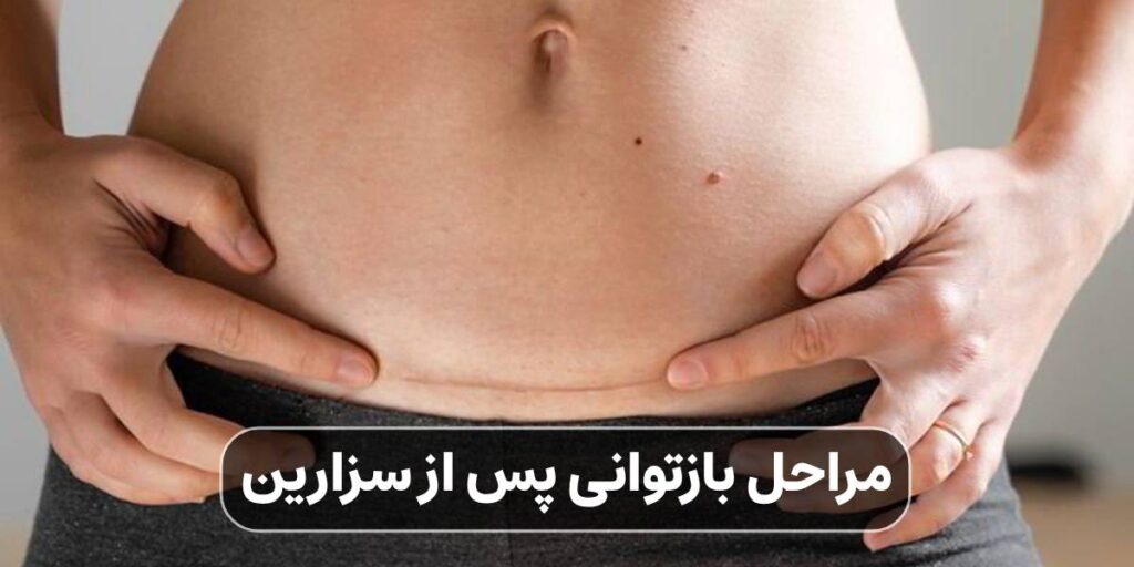 مراحل بازتوانی پس از سزارین