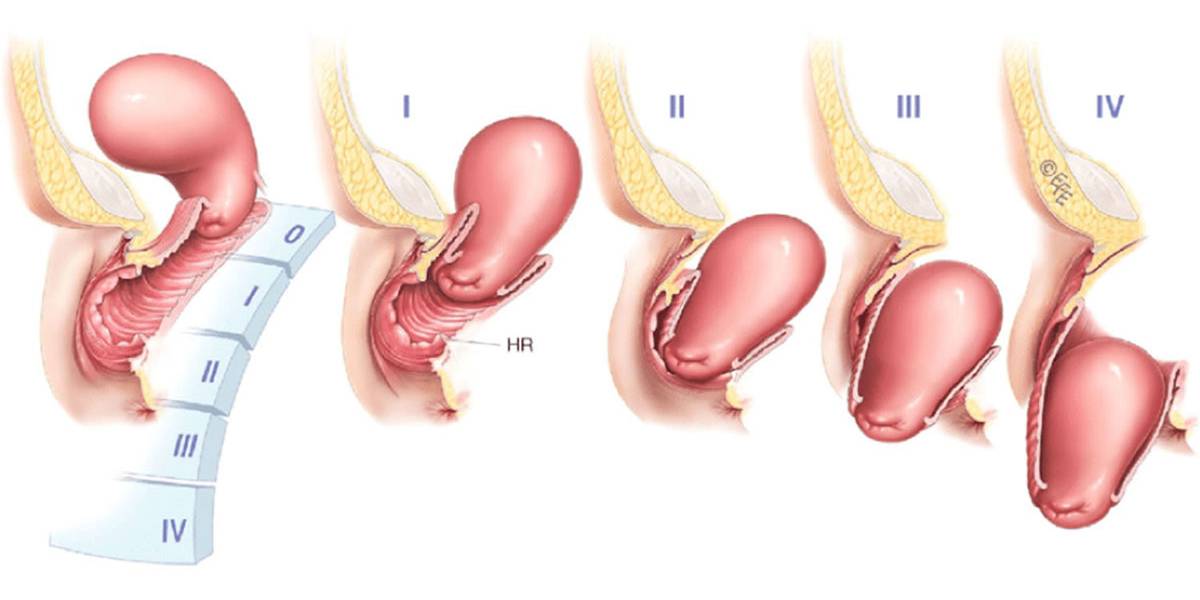 عمل افتادگی رحم