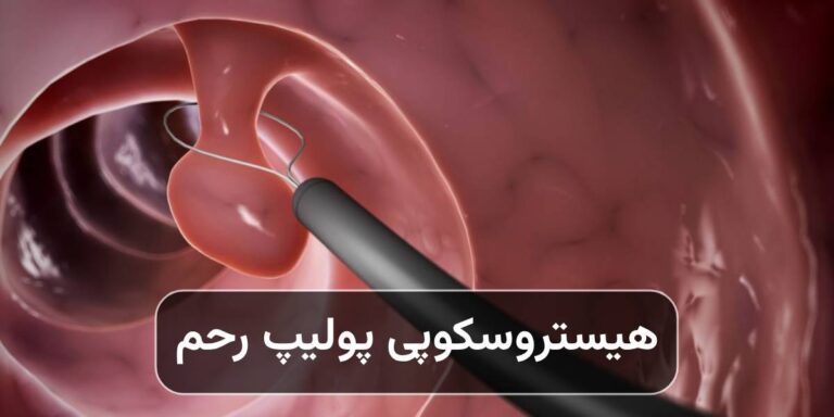 هیستروسکوپی پولیپ رحم؛ علائم و درمان