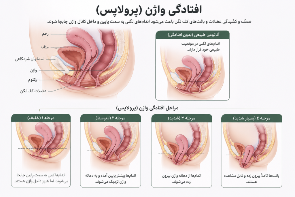 افتادگی واژن 